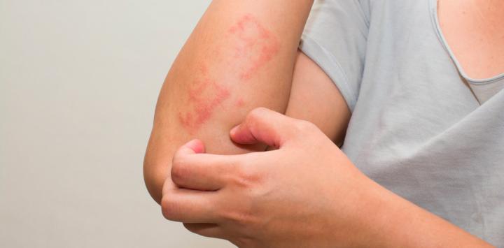 Como curar la psoriasis en el cuero cabelludo